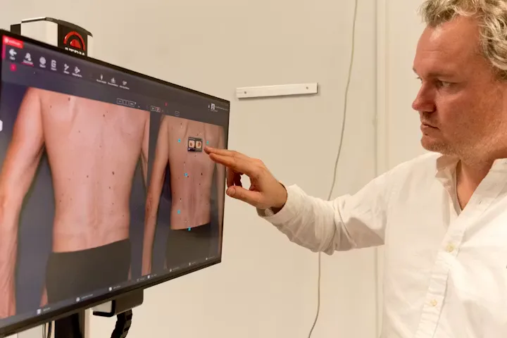 De Fotofinder van SkinTwin ziet elk (veranderend) plekje op de huid dat mogelijk kan wijzen op (het begin van) huidkanker. Foto: Johan Nebbeling